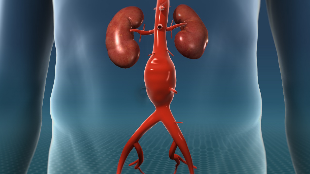 open-aortic-surgery-for-aneurysms-dr-ahmed-farah-abdulrahman