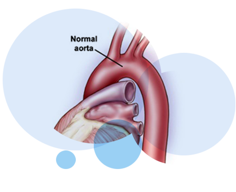 Aortic Aneurysm Treatment Gold Coast | Vascular GC